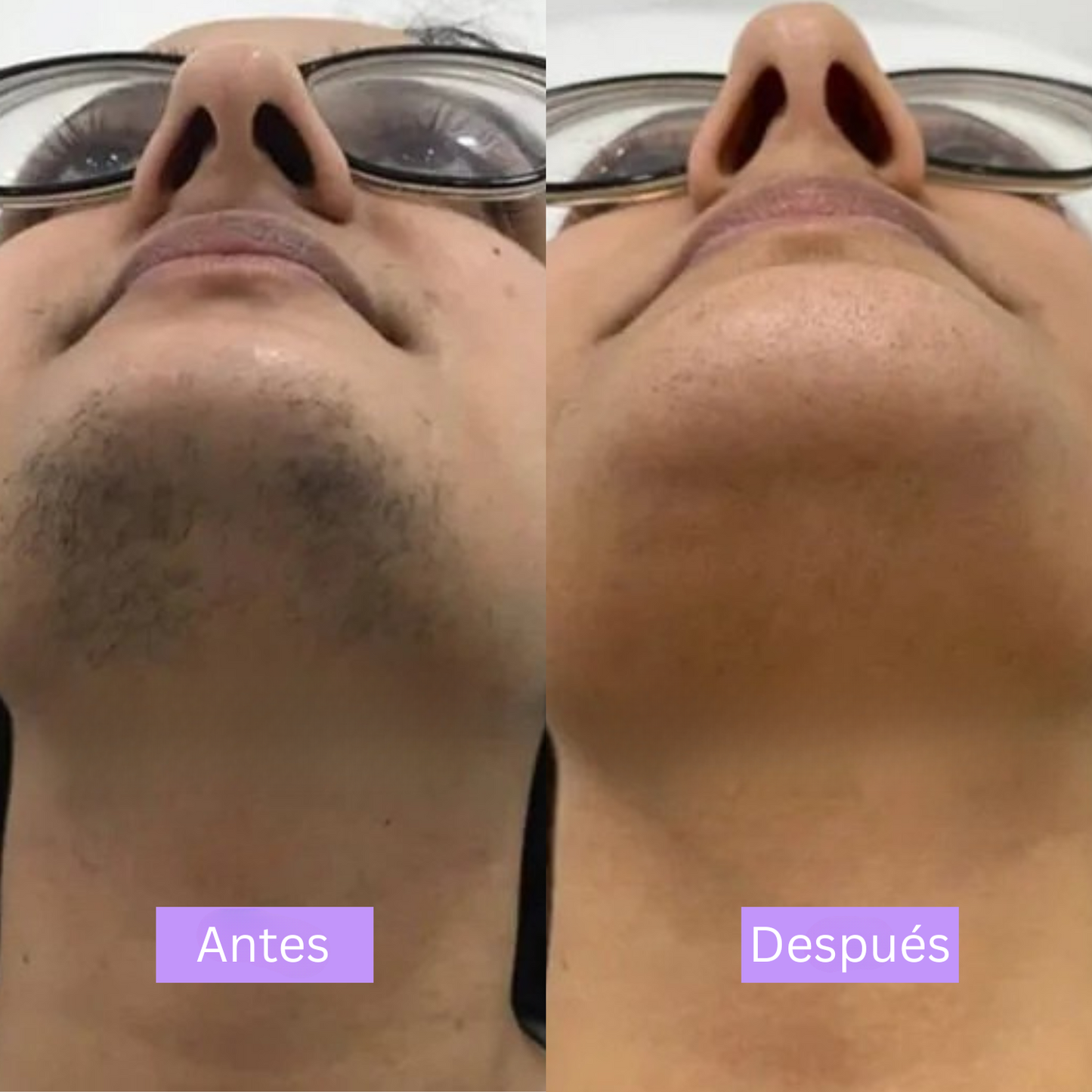 LinéaSkin™ - Serúm para los vellos de la piel Cyperus Rotundus