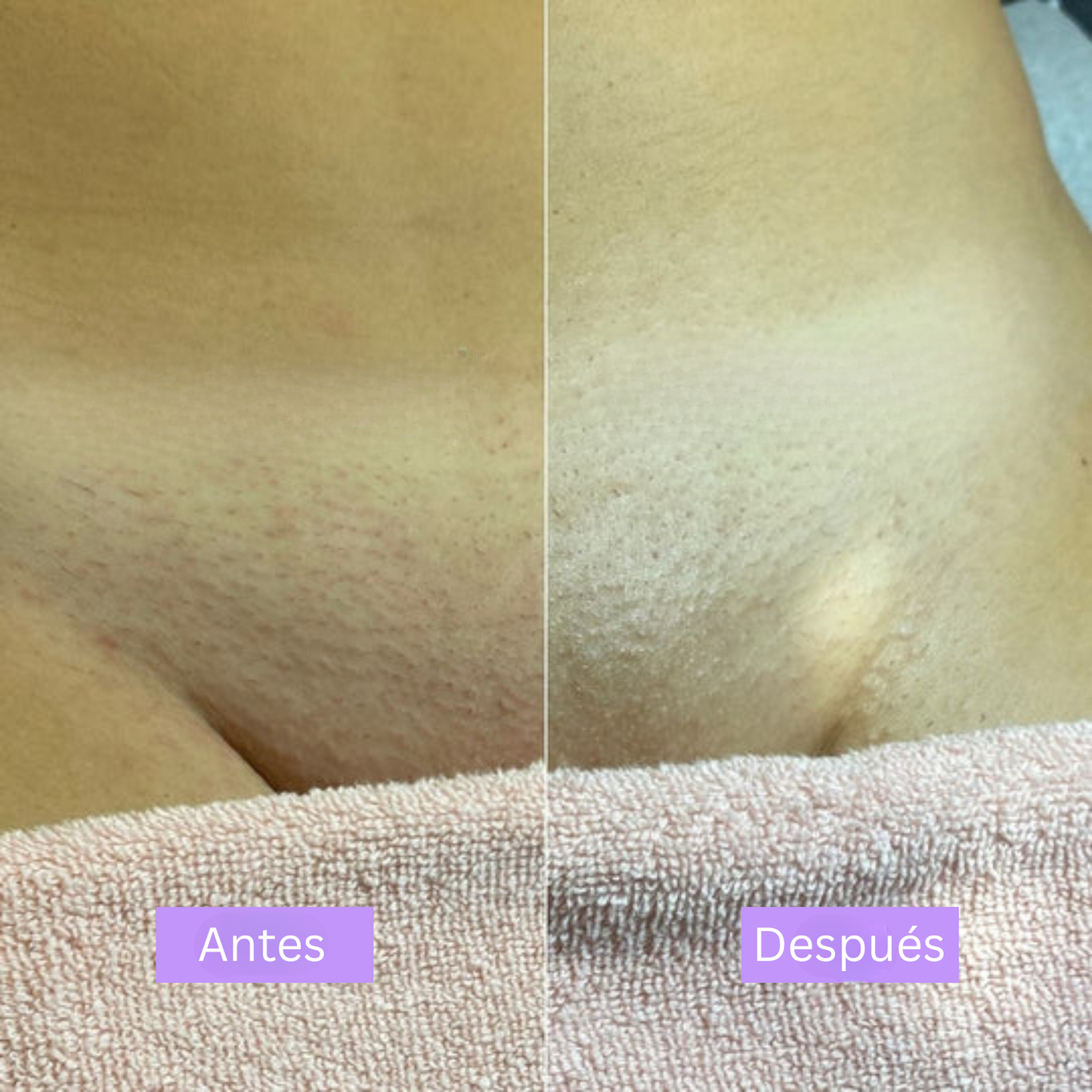 LinéaSkin™ - Serúm para los vellos de la piel Cyperus Rotundus