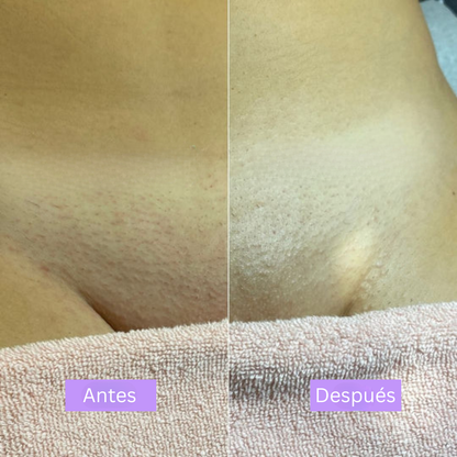 LinéaSkin™ - Serúm para los vellos de la piel Cyperus Rotundus